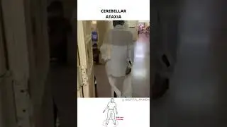 CEREBELLAR ATAXIA ( WIDE BASED GAIT)