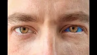 Blue sclera syndrome white part of the eye sclera appears bluish, gray, or purplish; Causes, symptom