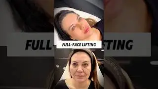 Natural-looking SMAS facelift with minimal downtime. #facelift #antiaging