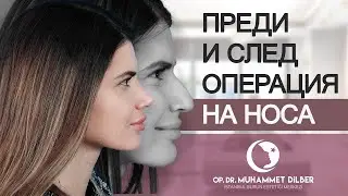 Преди и след операция на носа