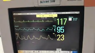 Electrical  alternans in cardiac monitor