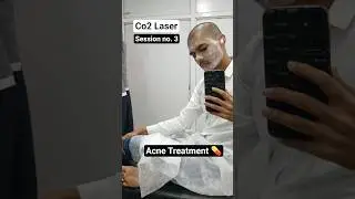 CO2 Laser Session 3: Let&rsquo;s go⚡️#co2laser #acnescars #acnetreatment