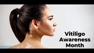 Vitiligo Awareness Month | Know, Accept, Support | Dr. Lalithya Dermatologist | Dr. Lalithya Derma