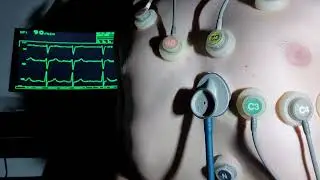(extremely) visible heartbeat / 10 lead EKG + Steth