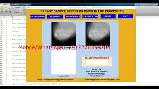 Breast Cancer Detection Using Image Processing | With Source Code | Matlab Breast Cancer Detection