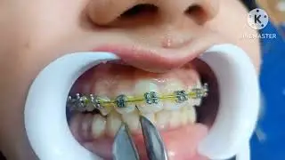 Dental braces removal and retainer on the same day