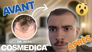 COSMEDICA Dr. Acar – Greffe de cheveux Turquie | Mois 2 : La repousse
