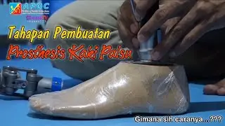 Tahap Pembuatan Prosthesis Kaki Palsu | APOC Medical | Dhoho TV Kediri