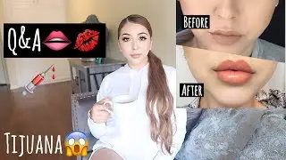 MY LIP INJECTION EXPERIENCE + Q&A