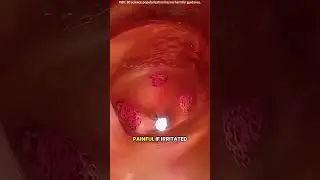 Pilonidal cyst treatment 3D animation #drone #theflash #space #automobile #scifi #facts #spaceracer