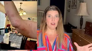 Allergic reaction to seizure medication!!!