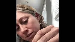 Applying ear seeds for anxiety