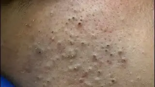Корейская система ухода за кожей с маслом чайного дерева для чистой кожи без акне