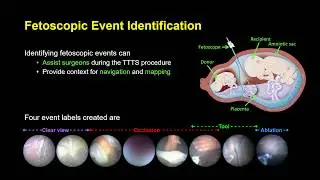 IPCAI2020 FetNet: A Recurrent Convolutional Network for Occlusion Identification in Fetoscopy Videos