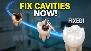 Cavity Removal Step-by-Step: The Modern Dental Filling Process in 3D 🛠️🦷