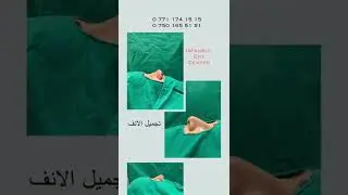 Rhinoplasty  - ISTANBUL ENT CENTER -0 750 165 51 51