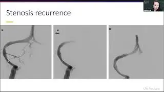 IIH: Stenosis Recurrence & Complications of Venous Sinus Stenting w/ Neurosurgeon Stephanie Chen, MD