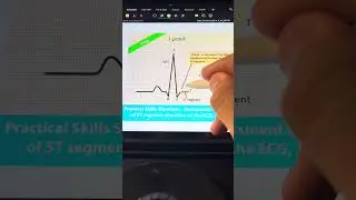 STEMI or NOT ?! #explore #اكسبلور #medstudent #ecg #medicine #er