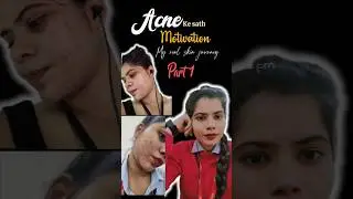 Acne + Worklife How To Deal 🤗 My Real Acne Journey #acnejourney