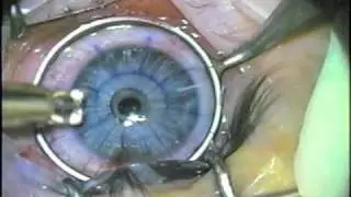 Radial Keratotomy 1 - Part 2