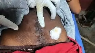 #StizDressing #StitchDressing #WoundCare #MedicalTutorial #youtubeshortsNursingSkil  #Trending2025