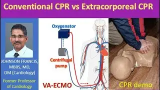 Conventional CPR vs Extracorporeal CPR