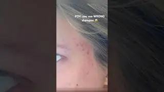 Got ACNE? Sure it&rsquo;s not your shampoo causing it?😱🤯#acne #acneproneskin #skincare #skincareforacne