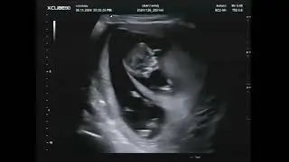 Pretecho 11 Weken Live Filmpje Tweeling