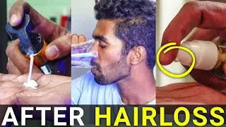 How I Maintain My Hair After Hair Fall Problem💊
