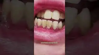 TopSmile Ultrasonic Tooth Cleaner Review 2024 Real Customer Results