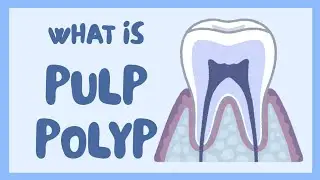 PULP POLYPS II Oral Pathology II HISTOLOGY