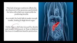 Type 5 Diabetes Explained | Causes, Symptoms & How It&rsquo;s Different from Other Types