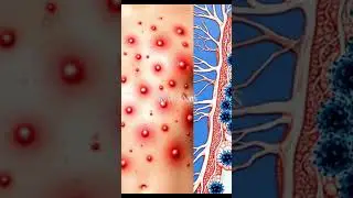 HERPES ZOSTER (SHINGLES): Reactivation and Dermatomal Attack #3DMedicalAnimation #Shingles #Herpes