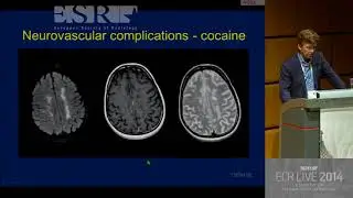 Neuro - Central nervous system changes after treatment   What you need to know 1