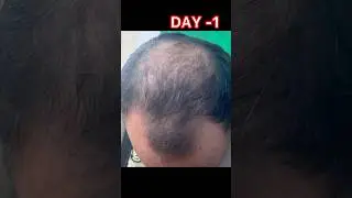 TDC advance hair regroth system || tdc hair growth kit ||tdc hair growth kit review #hairgrowth #TDC