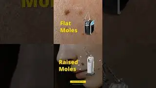 Remove Moles and Pigmentation Precisely with Laser