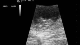 Ultraschall 10. Woche (9+6)