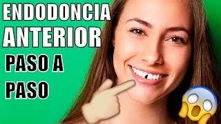 ENDODONCIA EN EL DIENTE DELANTERO- ME ROMP&Iacute; UN DIENTE -COMO ES UNA ENDODONCIA?- COMO M@TAR EL NERVIO