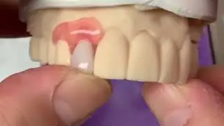 3D printed Mini Dentures