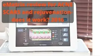 eMatrix for acne scars- in-depth review