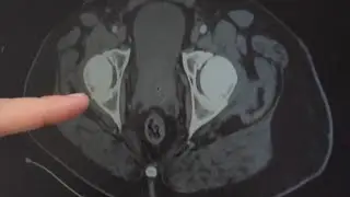 MU Health Care new laser surgery corrects enlarged prostates