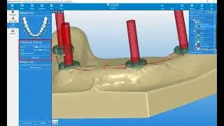 Reconstruction Setup  Overdenture, Scan Abutment Bar with Spacer for Locator