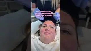Microneedling + PRP Platelet Rich Plasma Vampire Facial