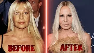 Celebrity Plastic Surgeries That Went Terribly Wrong | Shocking Before & After