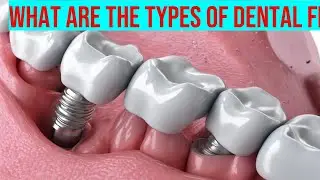 Which Dental Filling Material is Best for You? - Discover the Pros and Cons of Different Types!