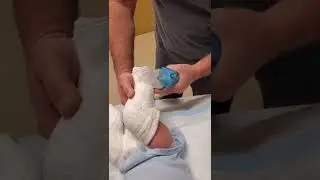 Снятие гипсового гипса при косолапости