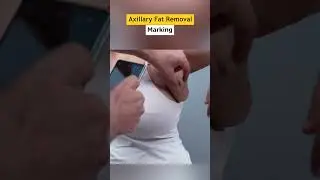 Axillary Fat Removal Video | Axillary Fat | Axillary Fat cost | Axillary Fat price