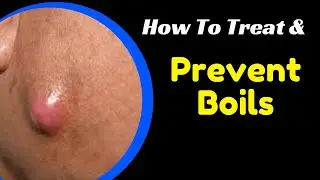 How to Treat and Prevent Boils  ( Head, Throat, Armpit) - Kasoa TV