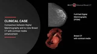 Breast CT with contrast media in comparison to Mammography