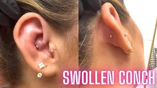 Jony's Vlog 008: Removing Swollen conch